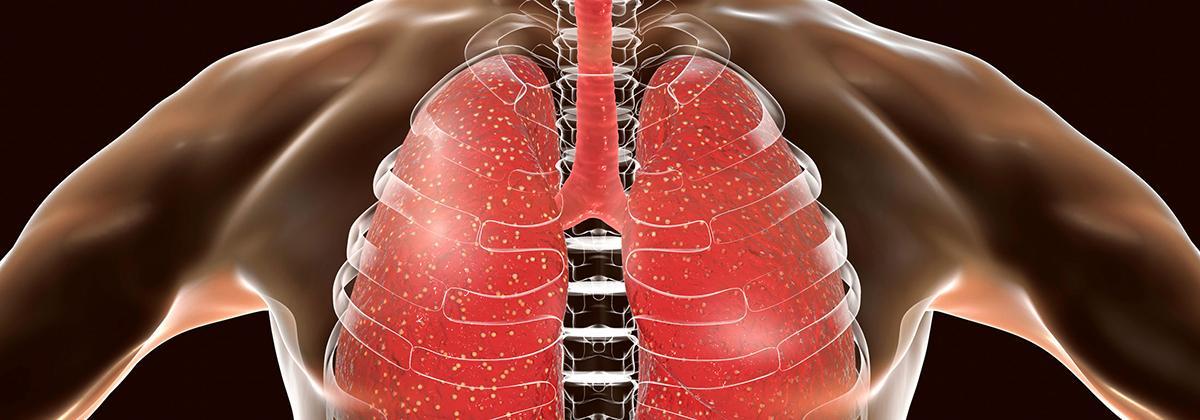 zoom poumons pour lutte contre la tuberculose